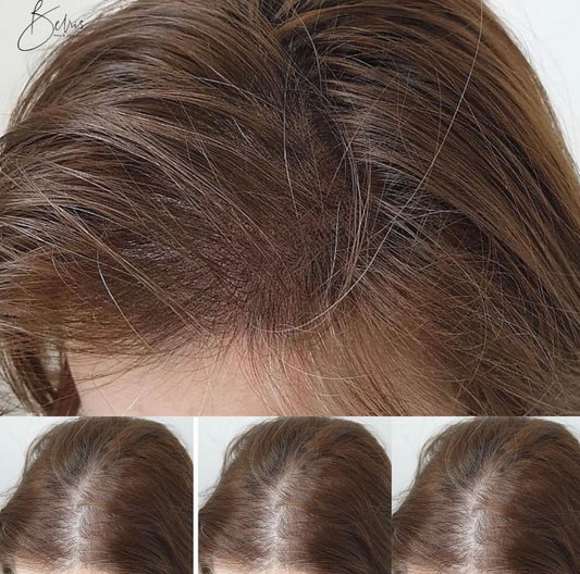 What is Scalp Micropigmentation?