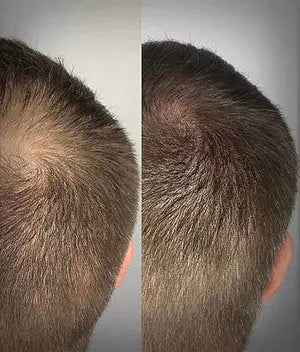Scalp Micropigmentation Los Angeles